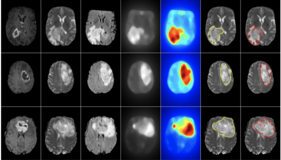MRI images of a brain, with three images highlighted and color-coded