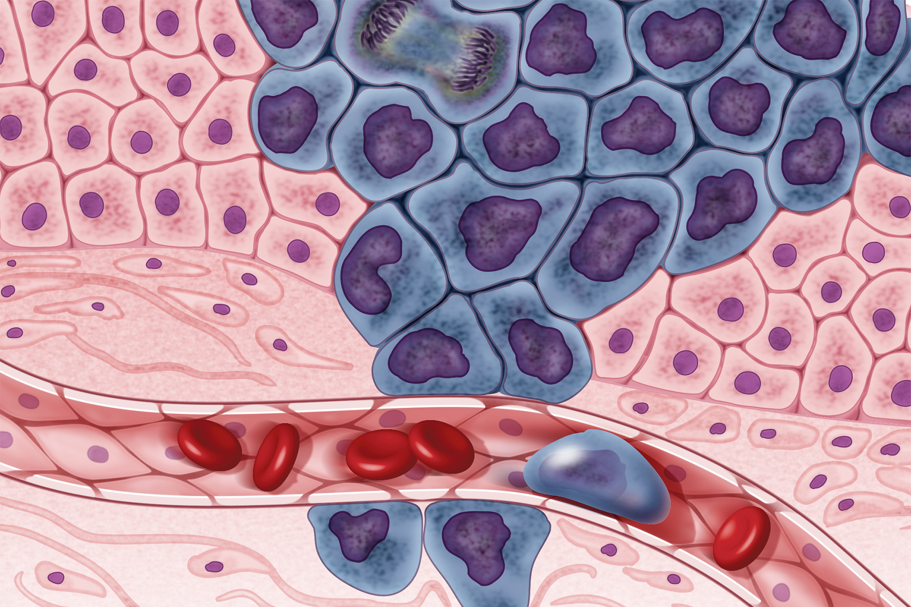 Illustration of cancerous cells entering the circulatory system